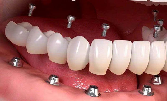 ایمپلنت دندان در مشهد
