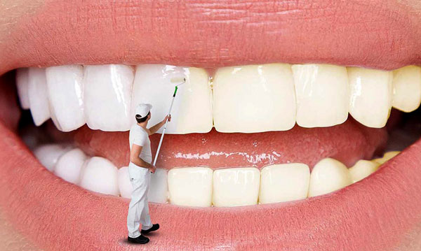 بلیچینگ دندان در مشهد ۲