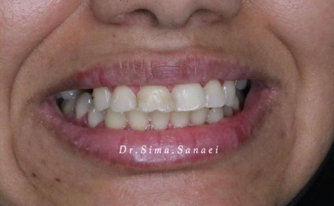 Dental laminate mashhad ۱