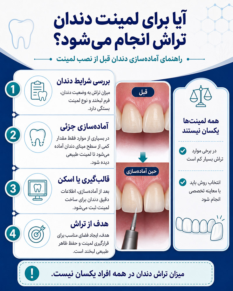 آیا برای لمینت، دندان تراش داده میشود