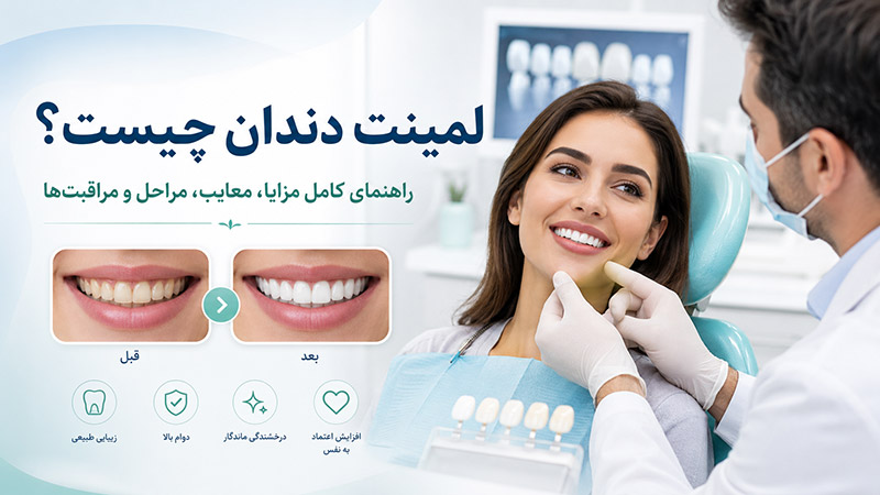 لمینت دندان چیست؟