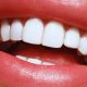 لمینت دندان چیست