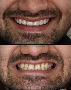 قبل و بعد لمینت دندان های فاصله دار