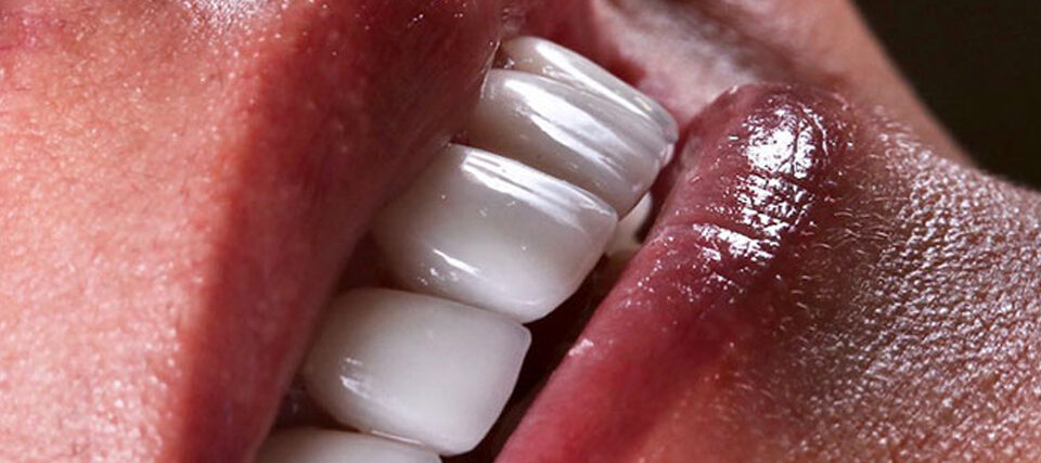 آیا لمینت دندان درد دارد؟