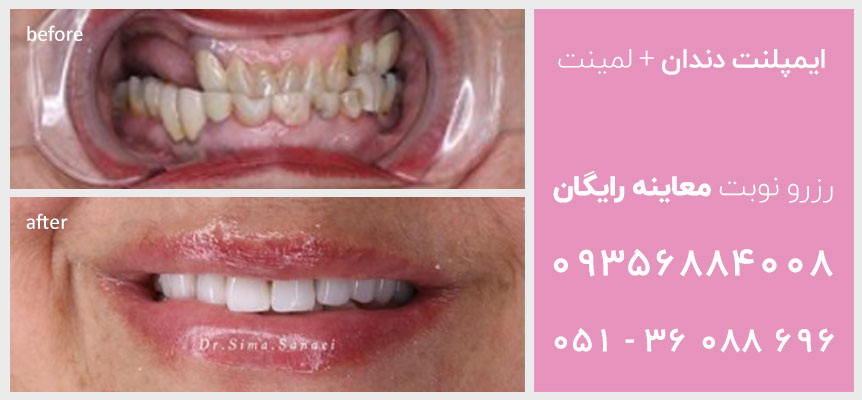 عکس قبل و بعد ایمپلنت دندان در مشهد