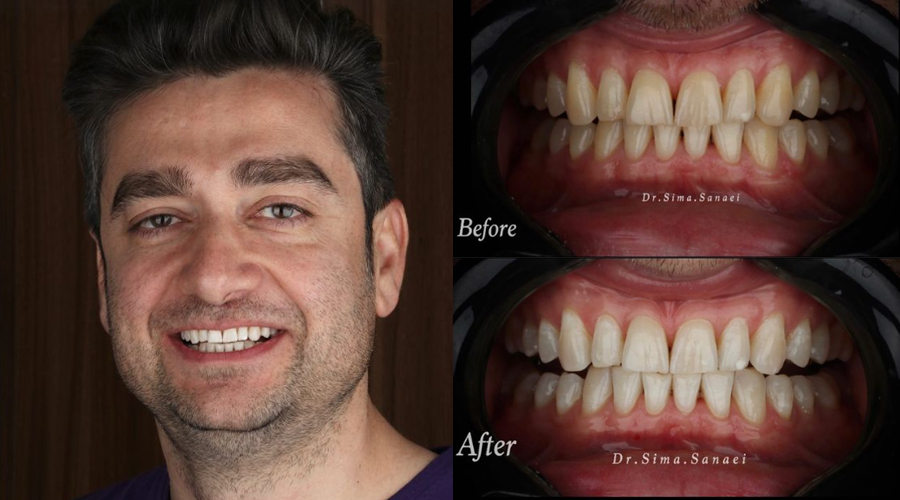 قبل و بعد بلیچینگ دندان در مشهد