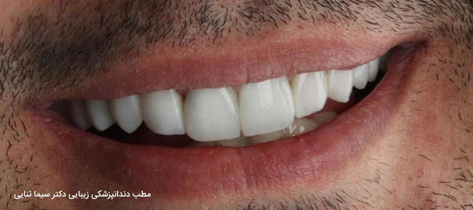 لمینت دندان عکس قبل و بعد