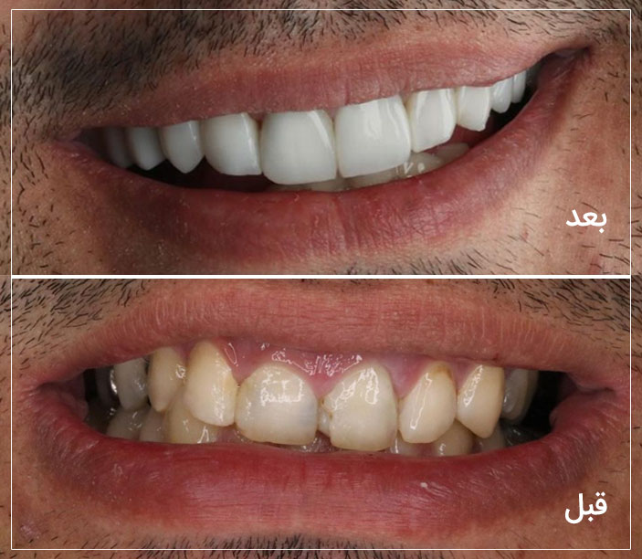 لمینت دندان مشهد عکس قبل و بعد