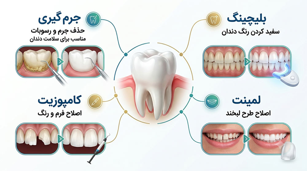 مقایسه جرمگیری، بلیچینگ، کامپوزیت و لمینت دندان؛ کدام روش برای شما مناسب است؟