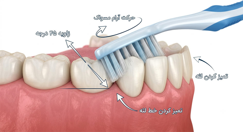 روش صحیح مسواک زدن برای جلوگیری از پلاک دندان
