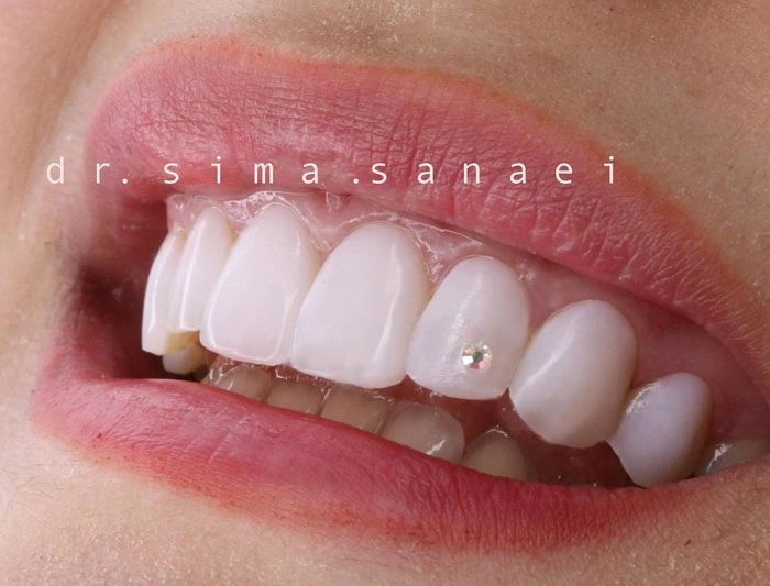تصویر لبخند زن با دندان های کامپوزیت شده در مطب دکتر سیما ثنایی در مشهد