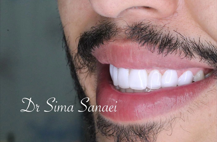 تصویر (لبخند) دندان های ونیر کامپوزیت شده