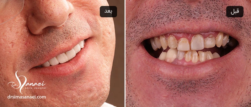 تصویر لبخند قبل و بعد از کامپوزیت دندان
