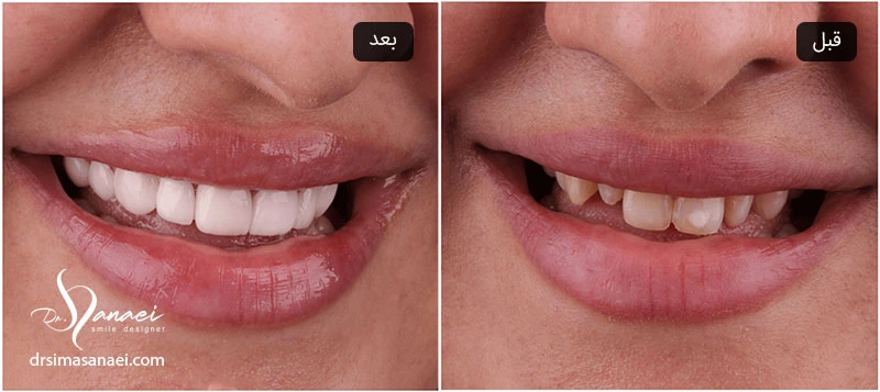 تصویر لبخند قبل و بعد از کامپوزیت دندان
