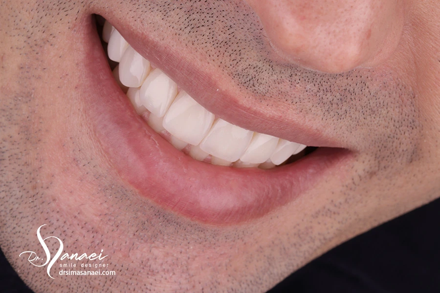 دنادن های کامپوزیت شده - ونیر کامپوزیت در مشهد