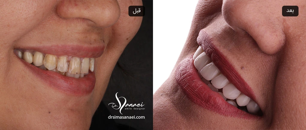 قبل و بعد کامپوزیت دندان در مشهد