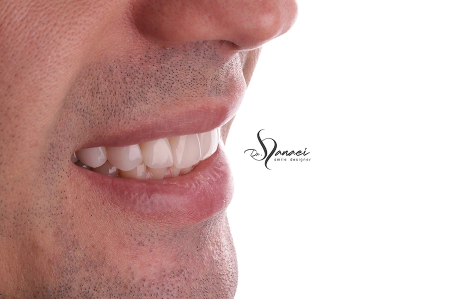 تصویر نیمرخ از لبخند مرد با دندان های کامپوزیت شده در مطب دکتر سیما ثنایی در مشهد