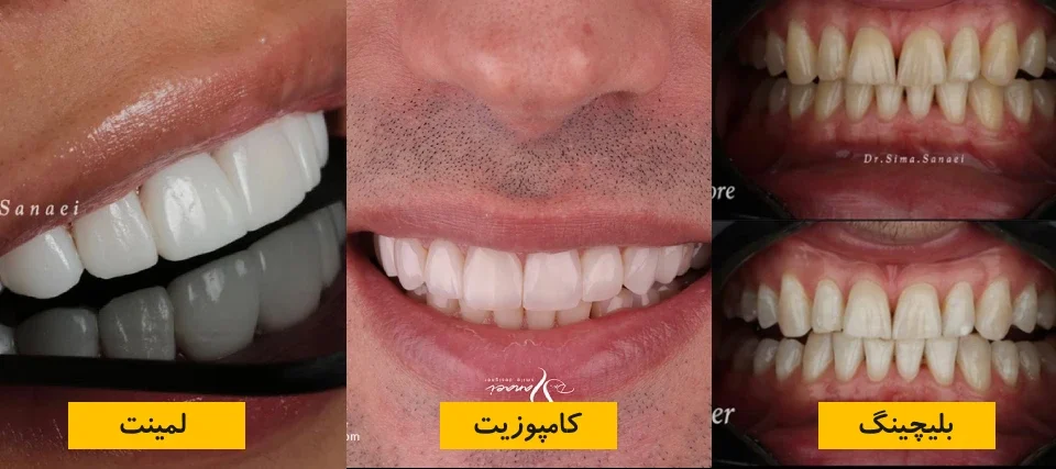 کامپوزیت بهتره یا لمینت یا بلیچینگ