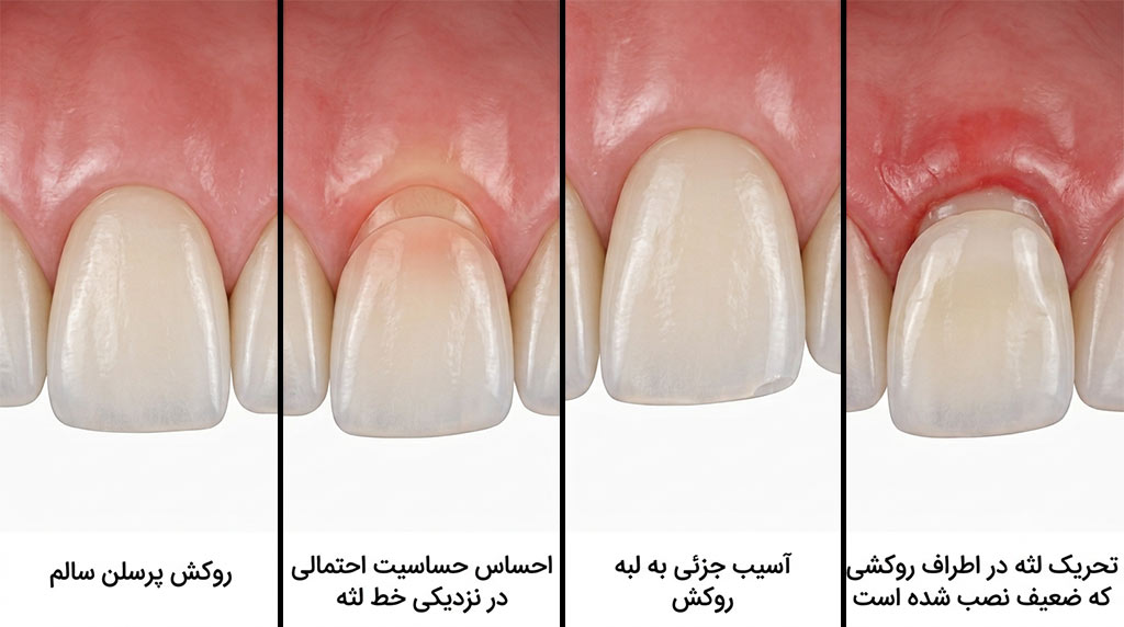عوارض احتمالی لمینت دندان مانند حساسیت و التهاب لثه