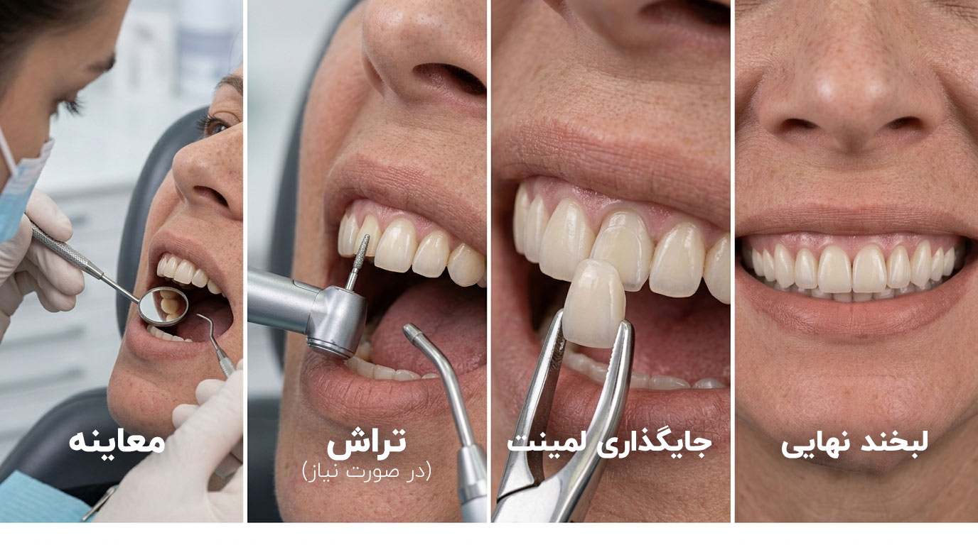 laminate-teeth-treatment-steps