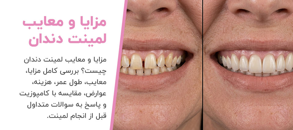 pros-and-cons-of-dental-laminate