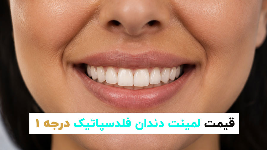 لمینت دندان فلدسپاتیک درجه ۱ با ظاهر طبیعی