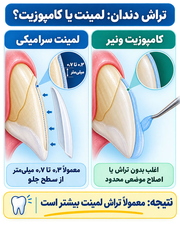 اینفوگرافیک مقایسه میزان تراش لمینت و کامپوزیت