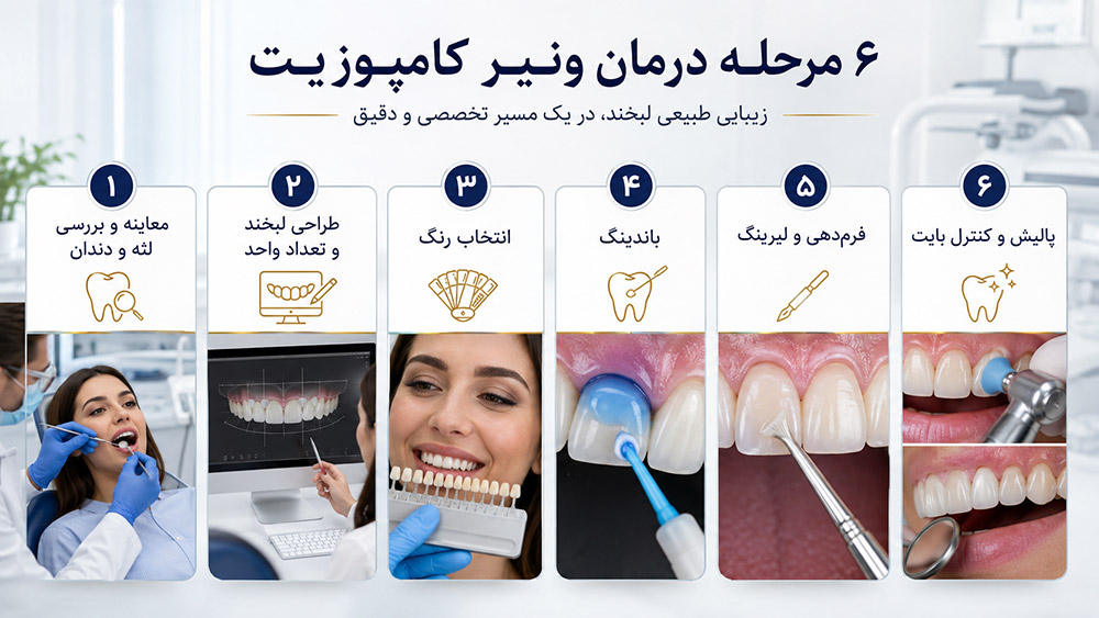 مراحل کامپوزیت دندان در مشهد