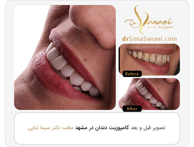 کامپوزیت دندان مطب دکر ثنایی