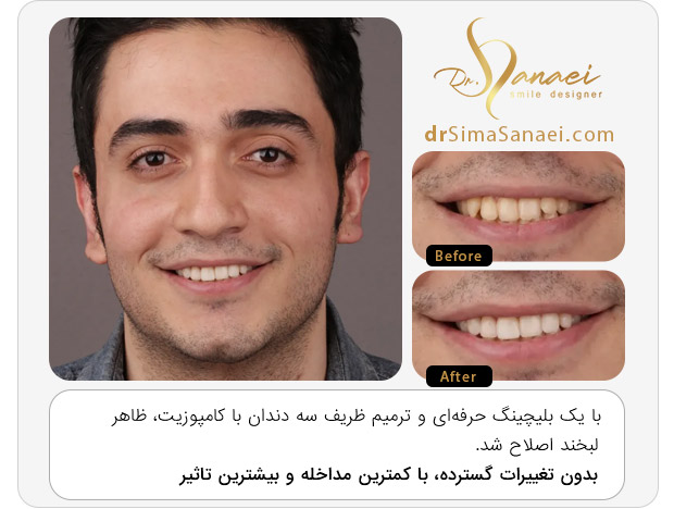 کامپوزیت دندان