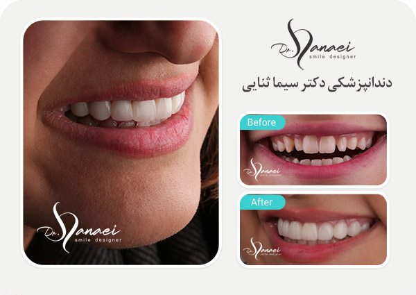 composite-veneer-mashhad-portfolio1