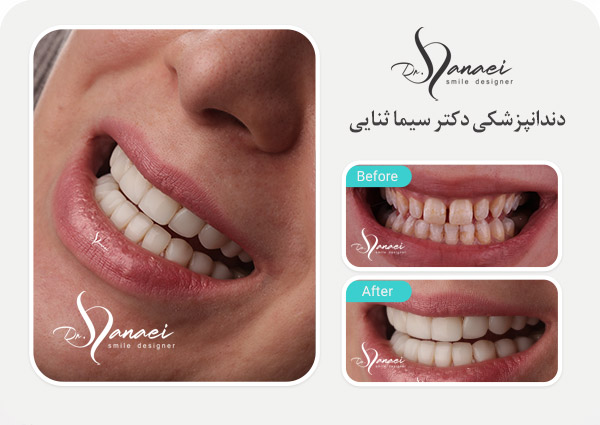 composite-veneer-mashhad-portfolio2