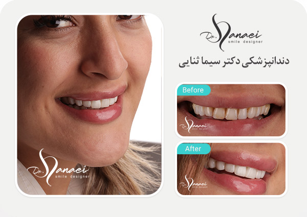 composite-veneer-mashhad-portfolio3