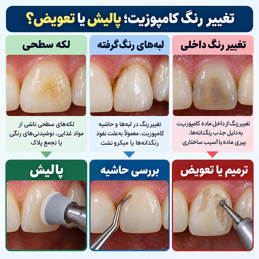 اینفوگرافیک پالیش، ترمیم یا تعویض کامپوزیت