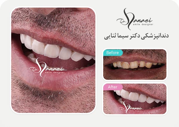 نمونه قبل و بعد لمینت سرامیکی دندان و اصلاح طرح لبخند