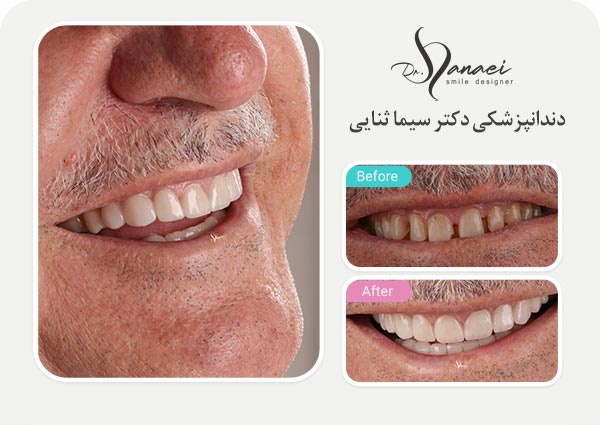نمونه قبل و بعد لمینت سرامیکی دندان و اصلاح طرح لبخند