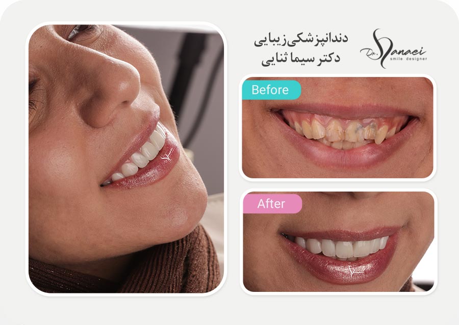 نمونه قبل و بعد لمینت سرامیکی دندان و اصلاح طرح لبخند