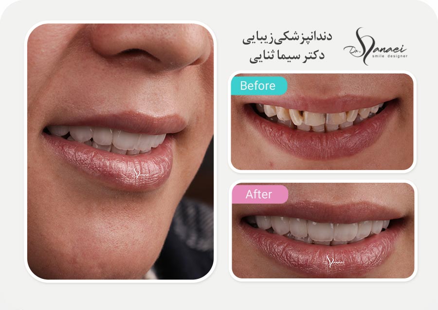 نمونه قبل و بعد لمینت سرامیکی دندان و اصلاح طرح لبخند