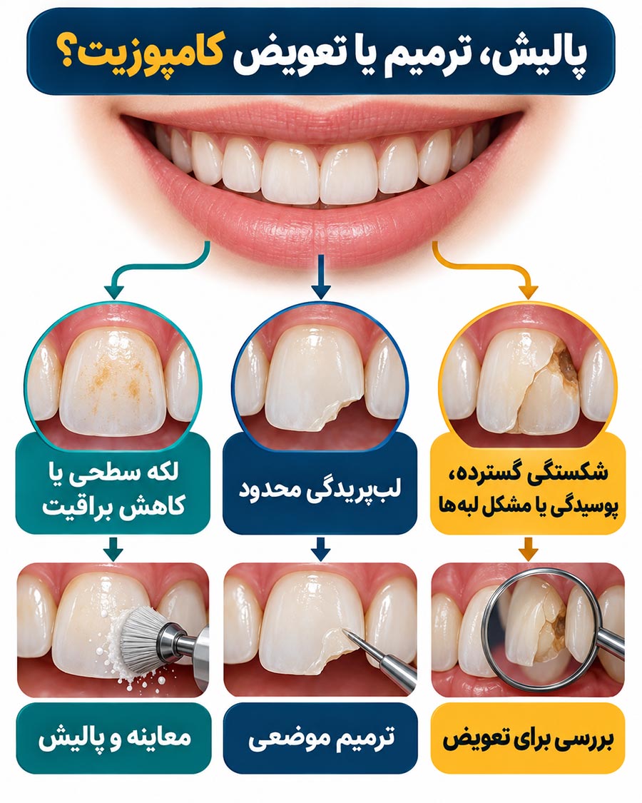 تفاوت پالیش، ترمیم و تعویض کامپوزیت دندان