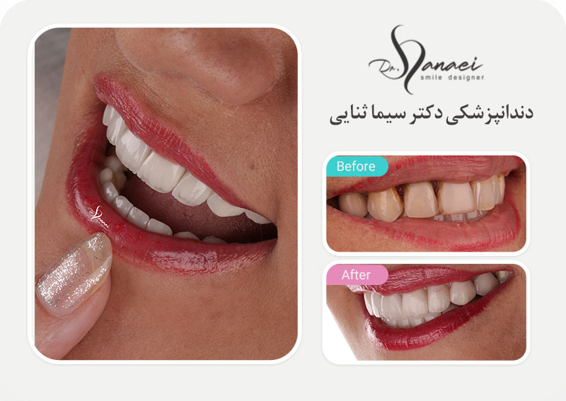 نمونه قبل و بعد لمینت سرامیکی دندان و اصلاح طرح لبخند