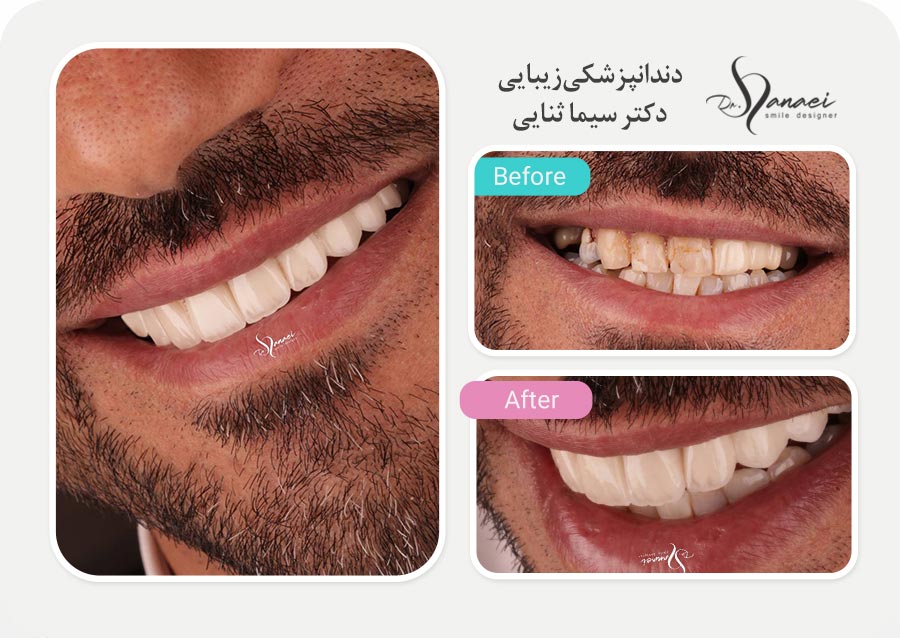 نمونه قبل و بعد لمینت سرامیکی دندان و اصلاح طرح لبخند